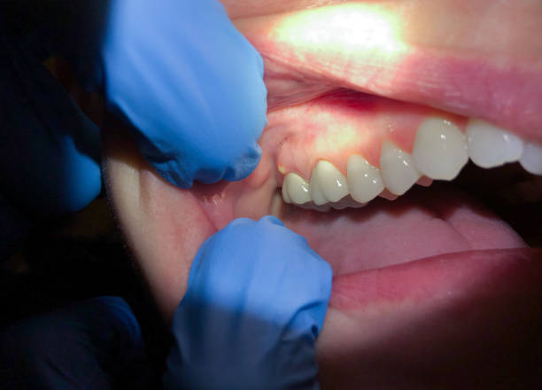 Best Emergency Root Canal Treatment in Danville, VA